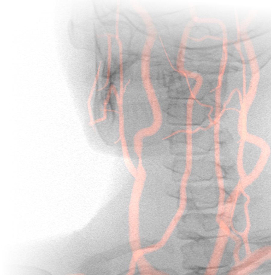 Angiographic view of the carotid and cerebral vessels in the simulation