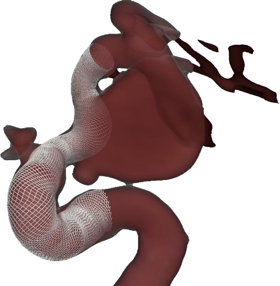 Aortic endograft deployed in a simulated aortic arch